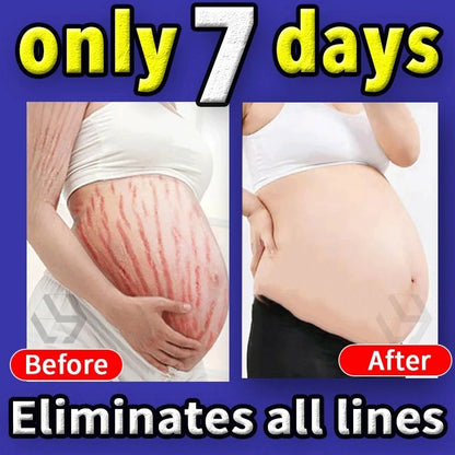 Stretch Mark Permanent Remover Stretch Mark Removal Cream White Stretch Mark Remover Stretch Mark Remover Free Shipping