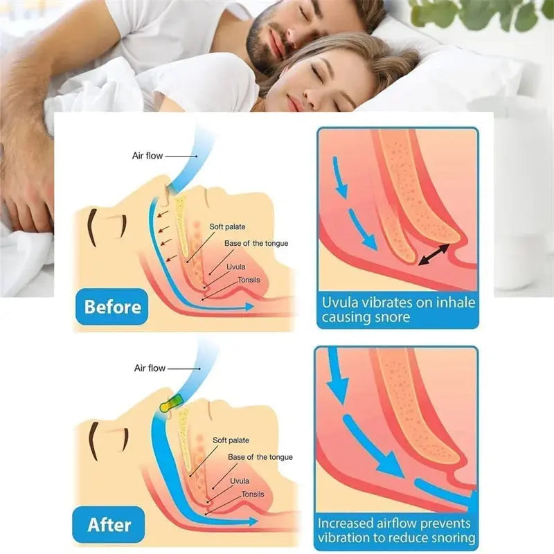 Anti-Snoring Corrector Snore Prevention Gadget Women's Anti-Snore Device Snore Elimination Nose Clip Men's Sleep Night TMSmartHub2021